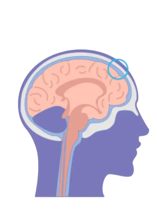 Corte del cráneo, las meninges y el cerebro.